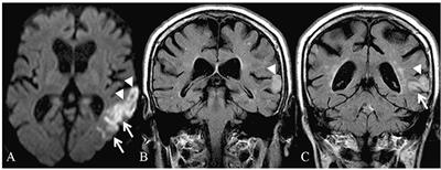 Facilitation of Auditory Comprehension After Theta Burst Stimulation of Wernicke's Area in Stroke Patients: A Pilot Study